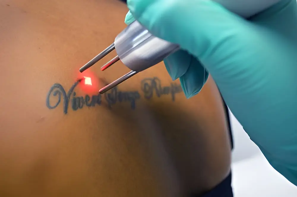 rimozione tatuaggi